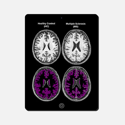 Qynapse releases new data demonstrating the value of QyScore® for the clinical