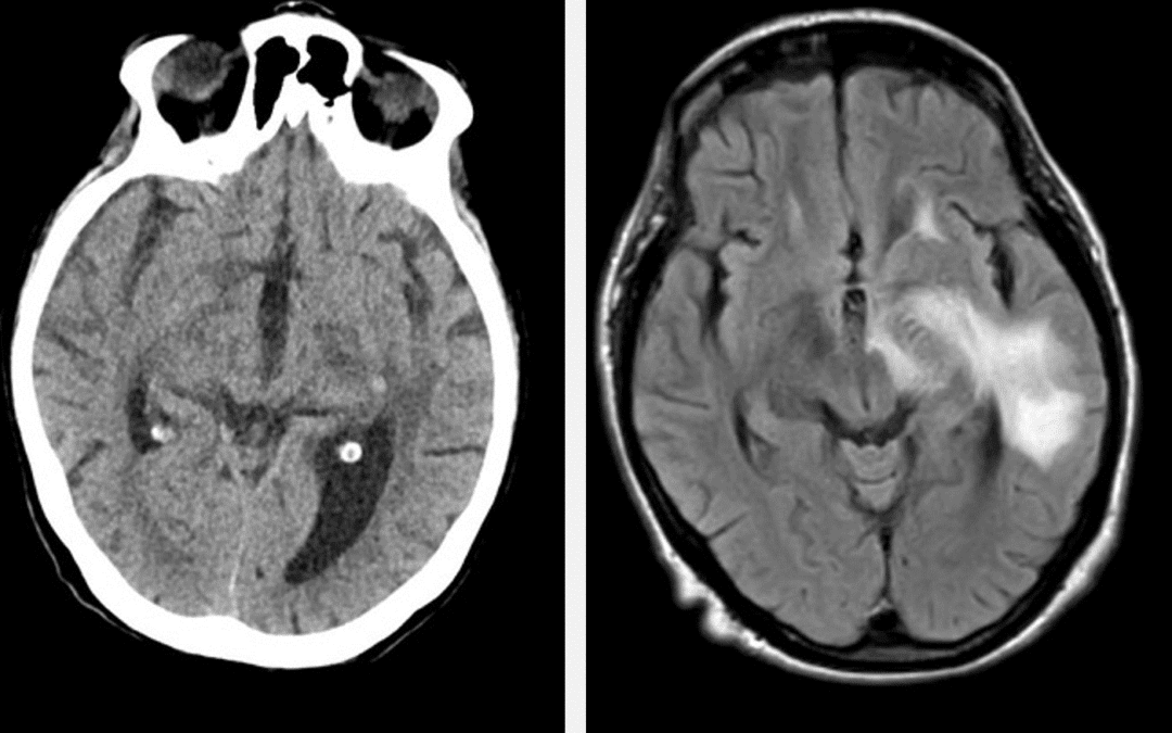 Qynapse supports the investigation of COVID-19 neurological manifestations