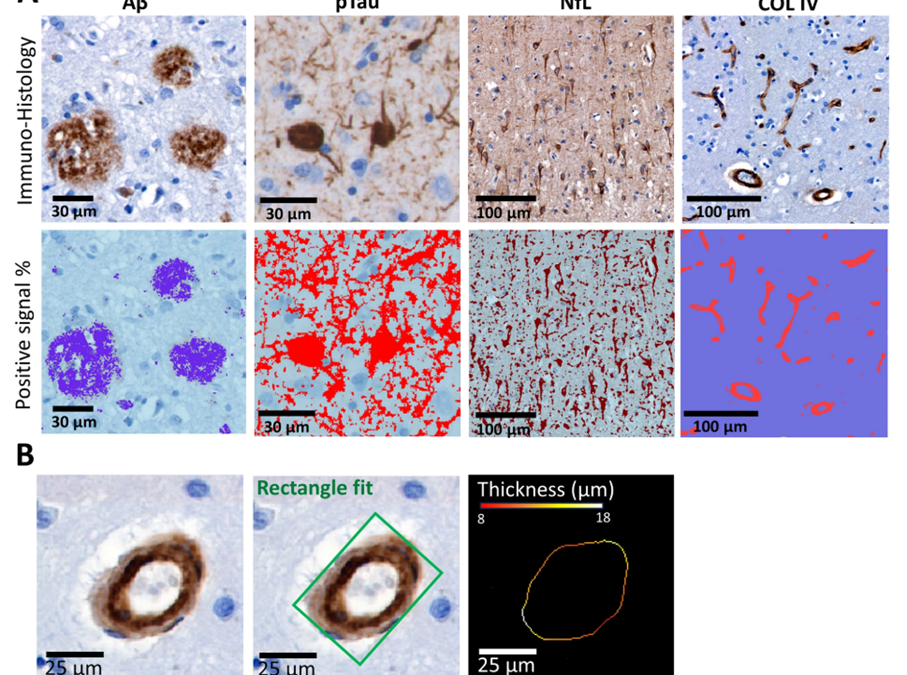 Qynapse and Amsterdam UMC Publish Landmark Study in Alzheimer’s Research & Therapy