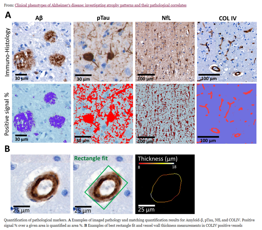 Qynapse and Amsterdam UMC Publish Landmark Study in Alzheimer’s Research & Therapy